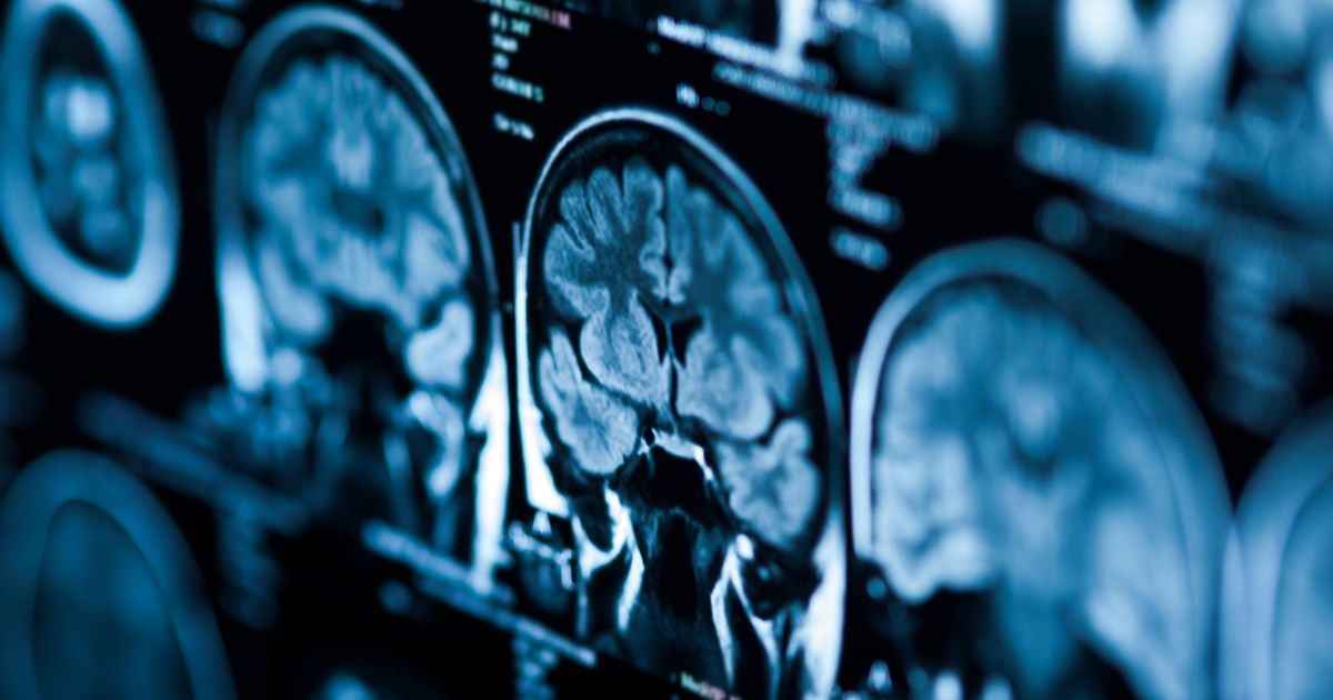 Bristol Myers Squibb's Krazati Bests Chemo in KRASMutant NSCLC With