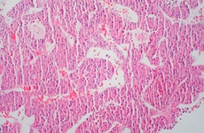 Hepatocellular_Carcinoma.jpg