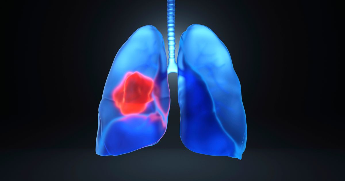 Lung cancer patients may benefit from delayed chemotherapy after