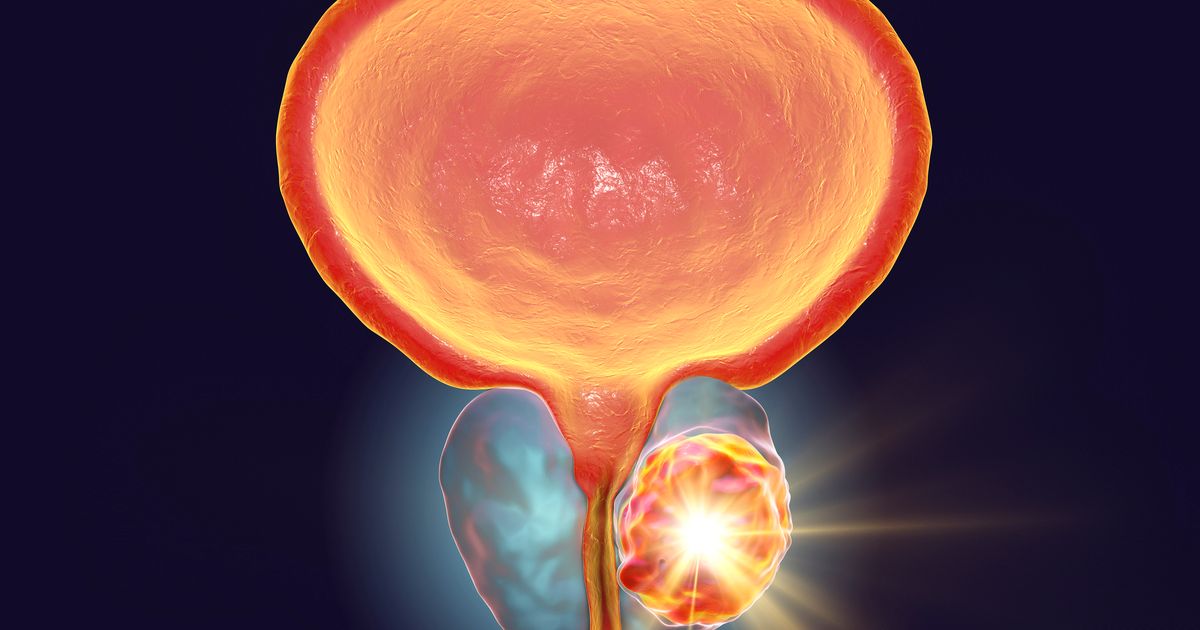 Role of SPOP Mutations in Prostate, Endometrial Cancer Come Into Focus ...