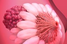 Breast cancer tumor