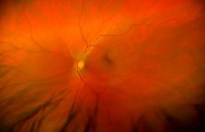 Image of a retina showing optical nerve