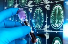 Scientist holding a patient's blood sample in front of a brain MRI scan as part of dementia research